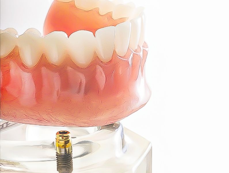 インプラント治療と組み合わせる入れ歯