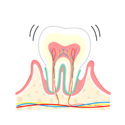 中度歯周炎（P2）