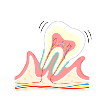 重度歯周炎（P3）